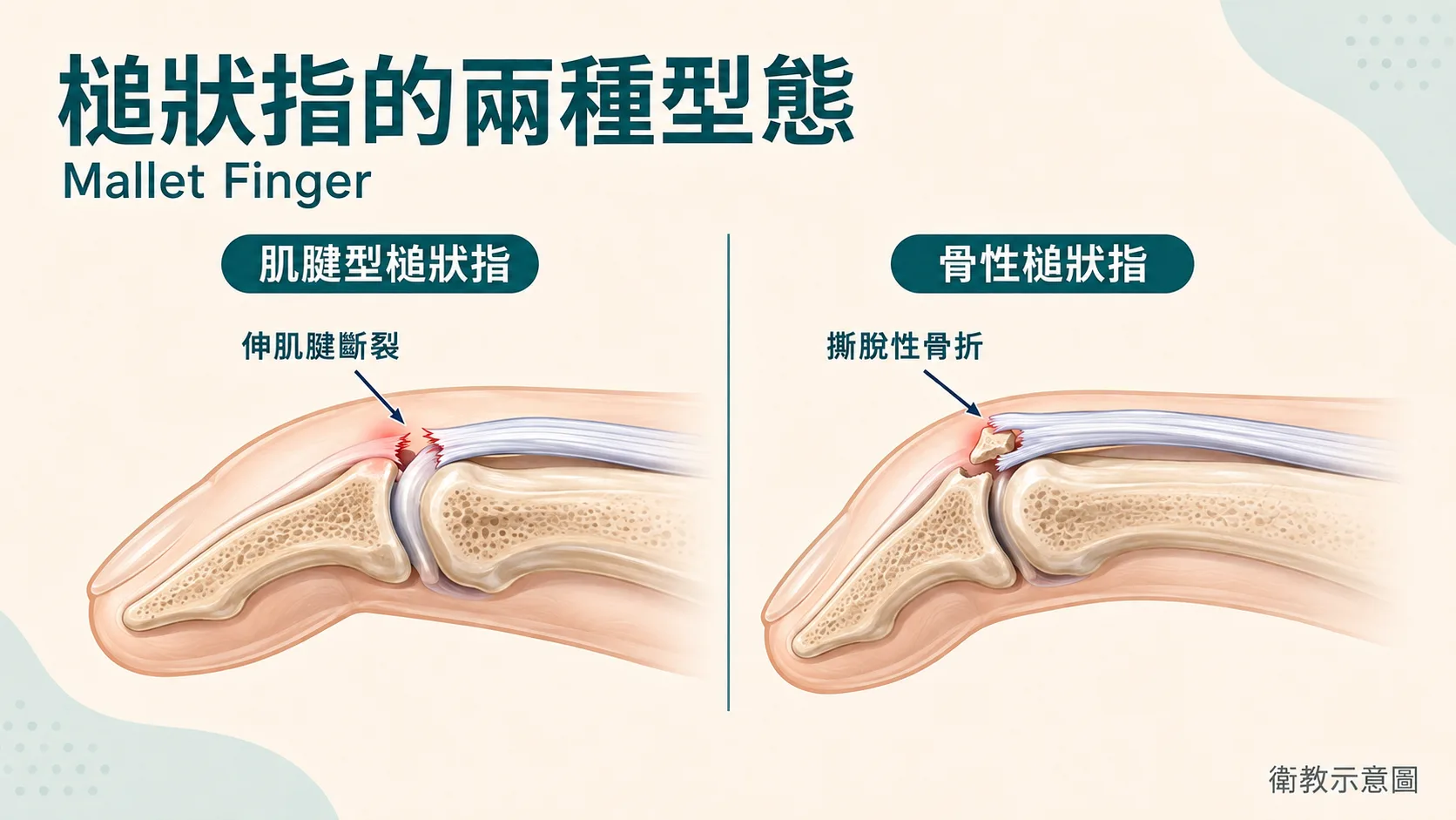 兩種不同型態的槌狀指,治療方式也不同